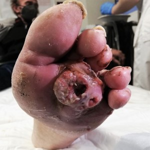 What lies beneath a maggot infestation of an ulcerated foot wound